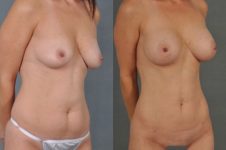 before and after liposuction female patient right diagonal view case 4725