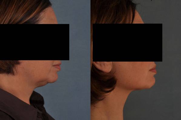 before and after liposuction female patient right side view case 4736