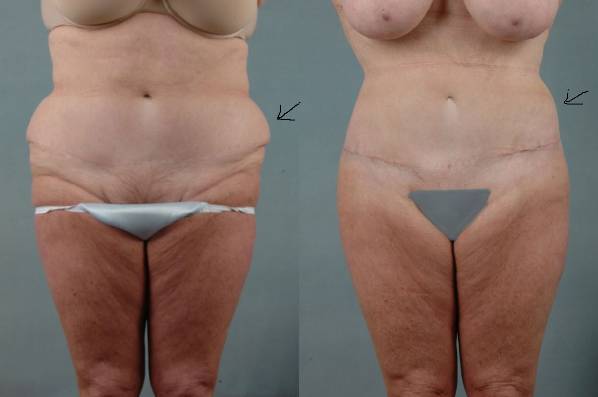 before and after liposuction female patient front view case 4739