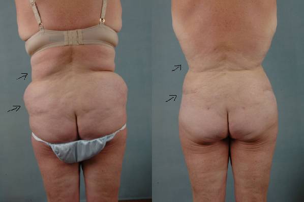 before and after liposuction female patient back view case 4739