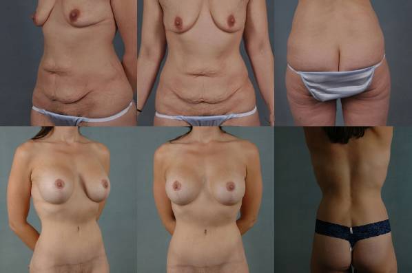 before and after liposuction female patient multiple angle view case 4744
