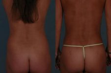 before and after liposuction female patient back view case 4753