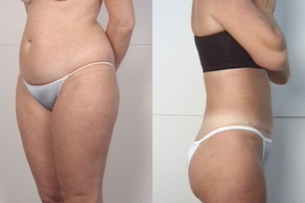before and after liposuction female patient multiple angle view case 4758