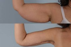 before and after liposuction female patient arm flexed view case 4764