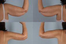 before and after liposuction female patient arm flexed view case 4764