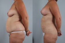 before and after liposuction female patient left side view case 4781