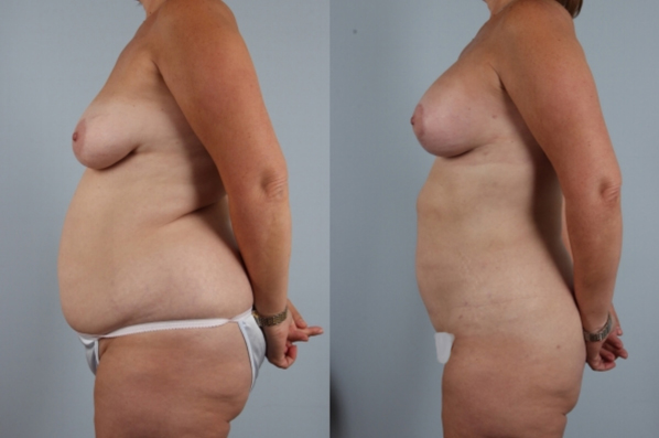 before and after liposuction female patient left side view case 4781