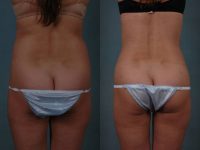 before and after liposuction female patient back view case 4787
