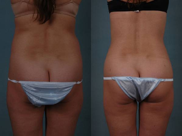 before and after liposuction female patient back view case 4787