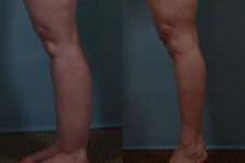 before and after liposuction female patient left side view of legs case 4790
