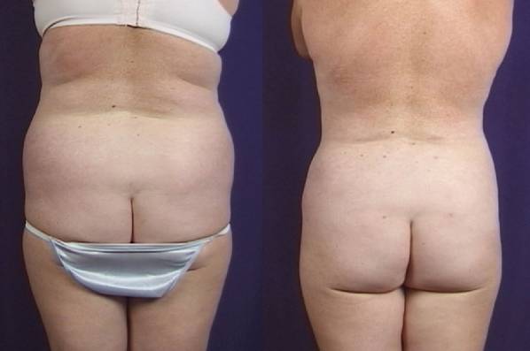 before and after liposuction female patient back view case 4795