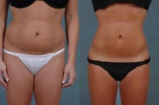 before and after liposuction female patient front view case 4798