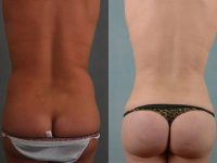before and after liposuction female patient back view case 4806