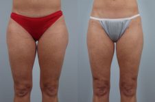 before and after liposuction female patient front view case 4809