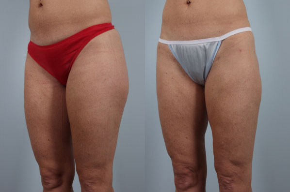 before and after liposuction female patient left diagonal view case 4809