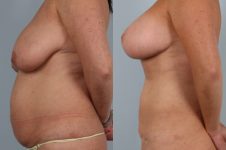 before and after liposuction female patient left side view case 4819