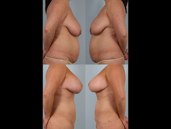 before and after liposuction female patient left and right side view case 4819