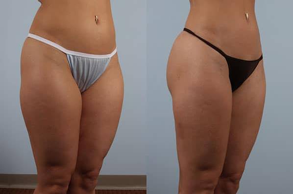 before and after liposuction female patient right diagonal view case 4824