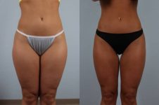 before and after liposuction female patient front view case 4824
