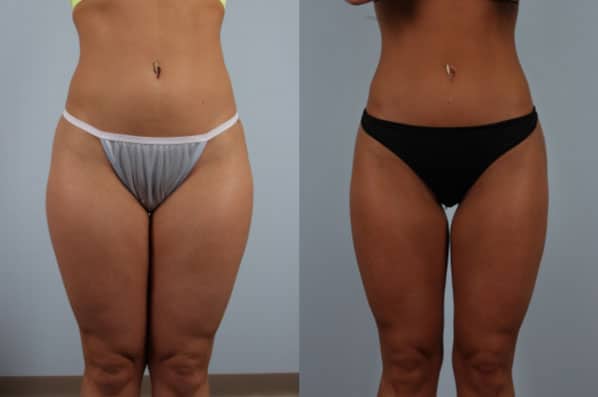 before and after liposuction female patient front view case 4824