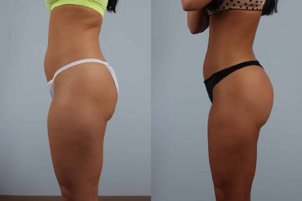 before and after liposuction female patient left side view case 4824