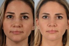 before and after liposuction female patient front view case 4833