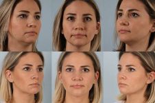 before and after liposuction female patient multiple angle view case 4833