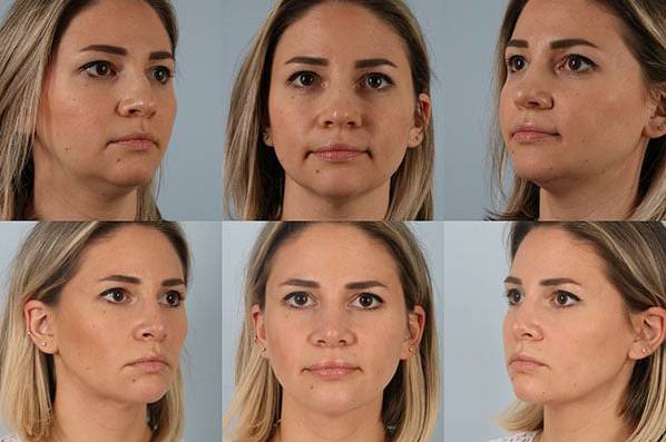 before and after liposuction female patient multiple angle view case 4833