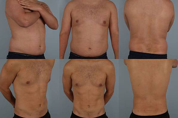 before and after liposuction male patient multiple angle view case 4838
