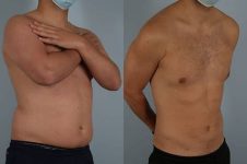 before and after liposuction male patient right diagonal view case 4838