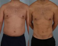 before and after liposuction male patient front view case 4838