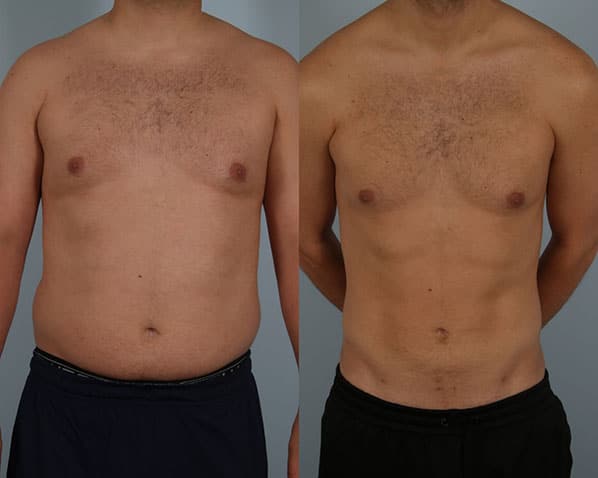 before and after liposuction male patient front view case 4838