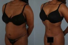 before and after liposuction female patient left diagonal view case 4843