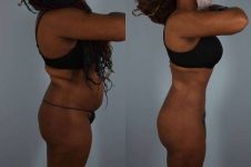 before and after liposuction female patient right side view case 4843