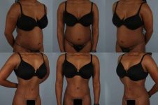 before and after liposuction female patient multiple angle view case 4843