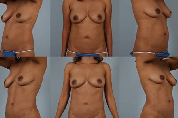 before and after liposuction female patient multiple angles view case 4813