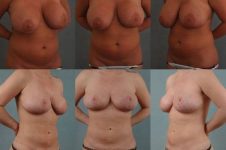 before and after liposuction female patient multiple angles view case 4806