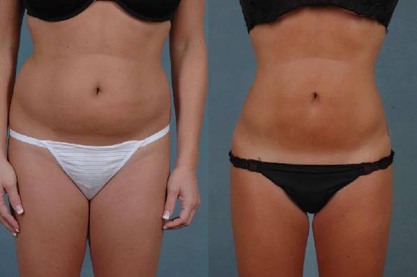before and after liposuction female patient front view