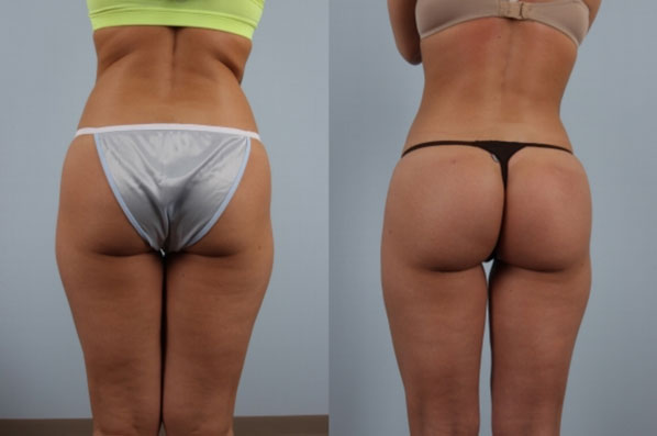 before and after of liposuction female patient back view