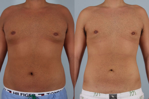 before and after male breast reduction front view