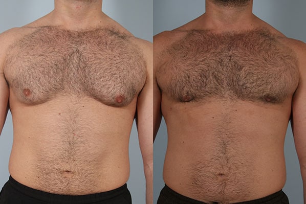 before and after male breast reduction front view