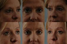 before and after eyelid surgery female patient multiple angles view case 8366