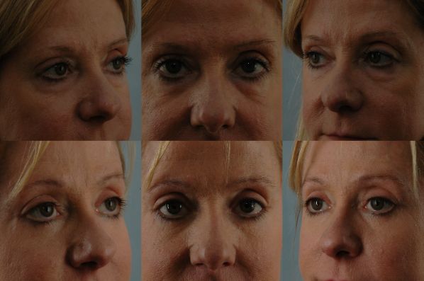before and after eyelid surgery female patient multiple angles view case 8366