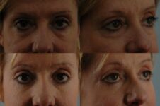 before and after eyelid surgery female patient multiple angles view case 8366