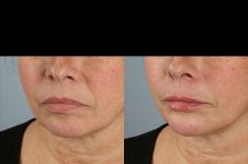before and after facial rejuvenation female patient left angled view case 8775