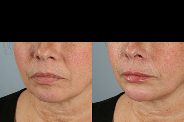 before and after facial rejuvenation female patient left angled view case 8775