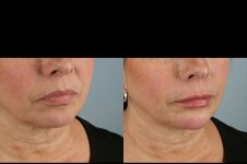 before and after facial rejuvenation female patient right angled view case 8775