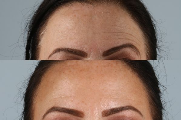 before and after facial rejuvenation female patient front view case 8779