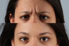 before and after facial rejuvenation female patient front view case 8781