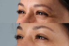 before and after facial rejuvenation female patient left angled view case 8781